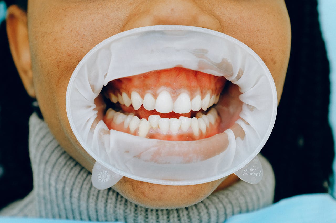 Detailed image of a woman's open mouth during a dental checkup using a cheek retractor.